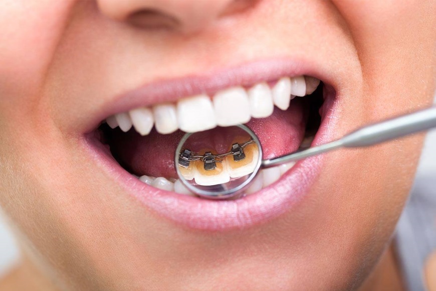 apparecchio denti adulti linguale